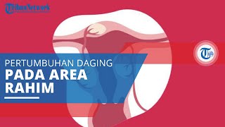 Mioma Uteri, Suatu Pertumbuhan Massa atau Daging di Dalam Rahim atau di Luar Rahim