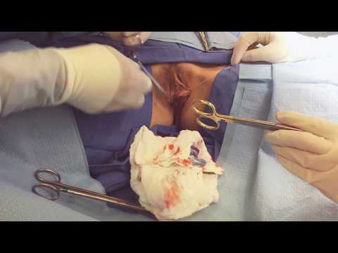 Labiaplasty - Live Surgery by Dr. Phillip Chang in Virginia www.GoToBeauty.com