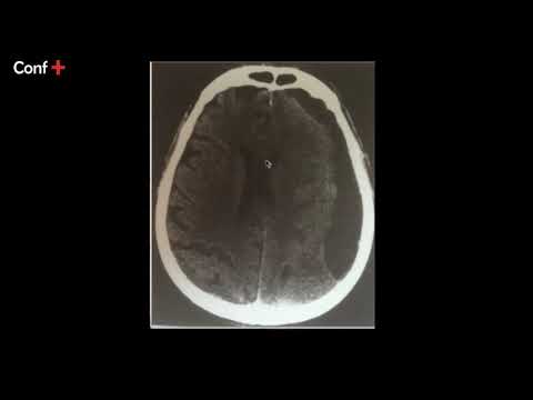 Cas d'imagerie (hématome sous-dural chronique)