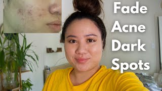 How to fade away acne dark spots + hyperpigmentation + acne marks