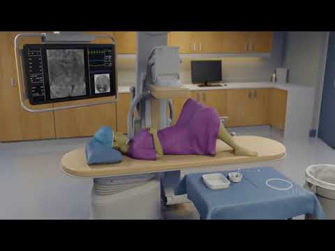 Fallopian tube recanalization