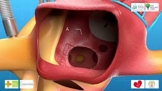 World's First Modified Senning's Operation 3D Medical Animation