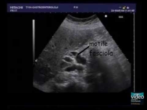 Fascioliasis forrás. Dr. Diag - Cholangiocarcinoma, Fascioliasis okai