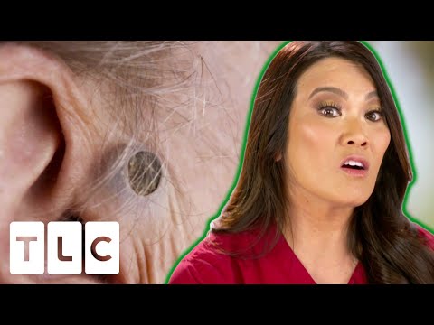 Dr. Lee Is Excited To Remove A 55-Year-Old Blackhead! | Dr. Pimple Popper: 12 Pops Of Christmas