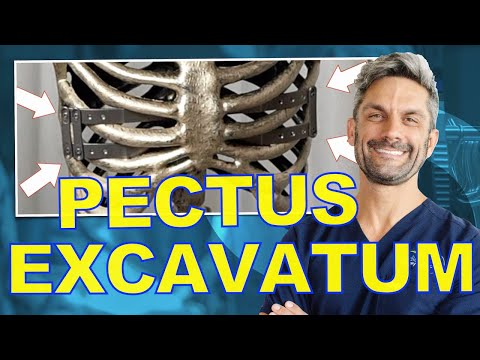 New Surgical Option for Pectus (Funnel Chest)