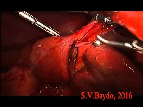 Laparoscopic Left Lateral Sectionectomy