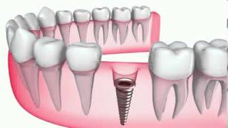 implantedental-murcia - Clínica Dental Vistabella