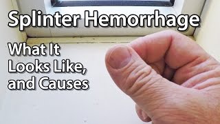 Splinter Hemorrhage - What It Looks Like, and Causes