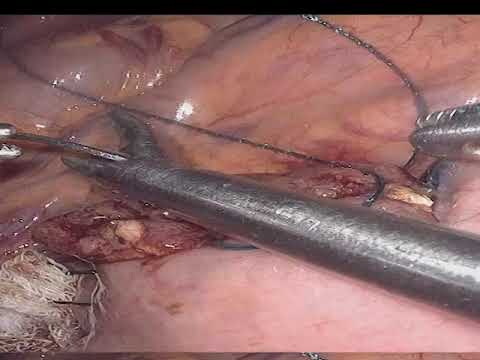 VATS Thymectomy for Large Thymoma