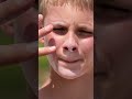 Yuen: Why does Minnesota have so much melanoma?