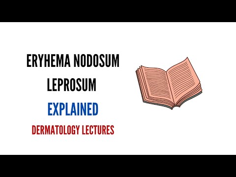 Erythema nodosum visszérrel - Lehet-e visszérrel fürdeni