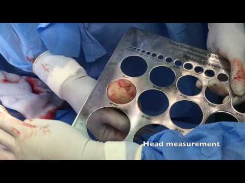 Arthrose des Knöchels und ein Pfeffer-Patch Injektionen Schema Osteochondrose
