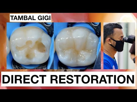 Step by step Filling Composite Lower Molar Direct Restoration Class I