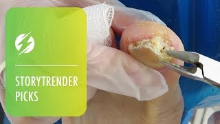 Podiatrist Treats Oozing Infected Toenail