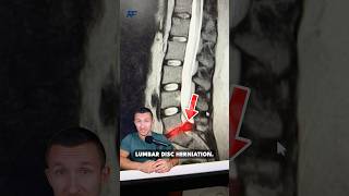 Download lagu MASSIVE Disc Herniation in Low Back! mp3