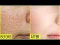 how-to-get-rid-of-large-open-pores-permanently-01-08-2019