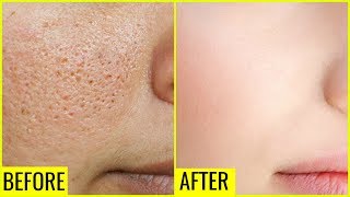 How to Get Rid of Large OPEN PORES Permanently | Anaysa