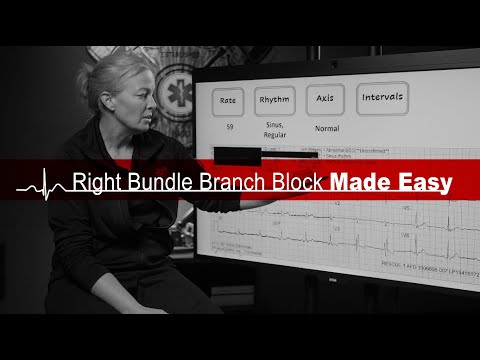 Right Bundle Branch Block Made Easy
