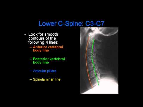 Radiology of Spine Trauma