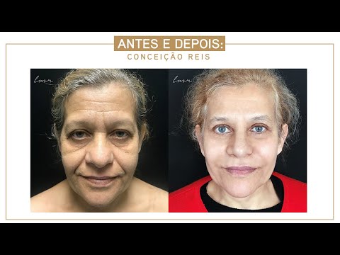 Lifting Facial com Blefaroplastia e Rinoplastia + Laser CO2