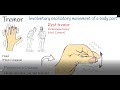 Tremor - Shaking hands (hand tremors) Causes and treatment.  Parkinson or Physiological Tremor?
