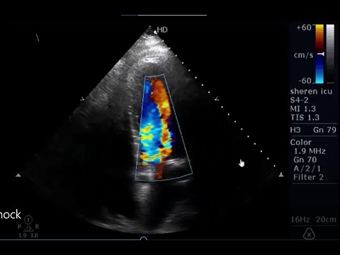 6 new lessons in management of shock by critical care Echocardiography