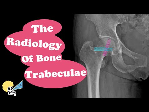 The Radiology of Bone Trabeculae