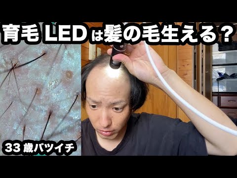 [Premature Baldness] A 33-year-old divorced man tests whether hair growth LEDs can help grow hair...