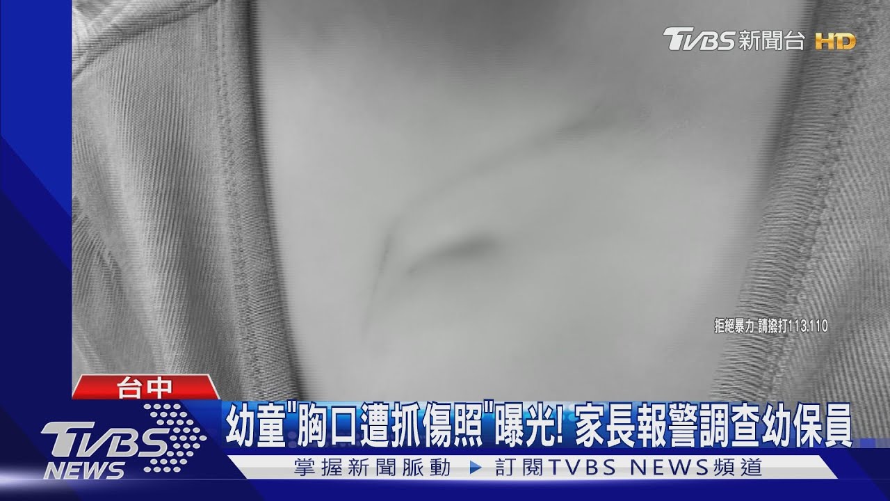 幼童「胸口遭抓傷照」曝光! 家長報警調查幼保員