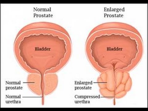 Iperplasia prostatica benigna cure naturali