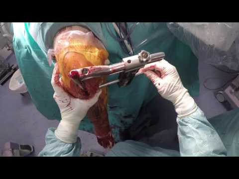 Polso osteoporosi giunto Joint Uzi Krasnoyarsk