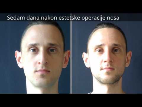 Usporedni prikaz prije i poslije operacije nosa
