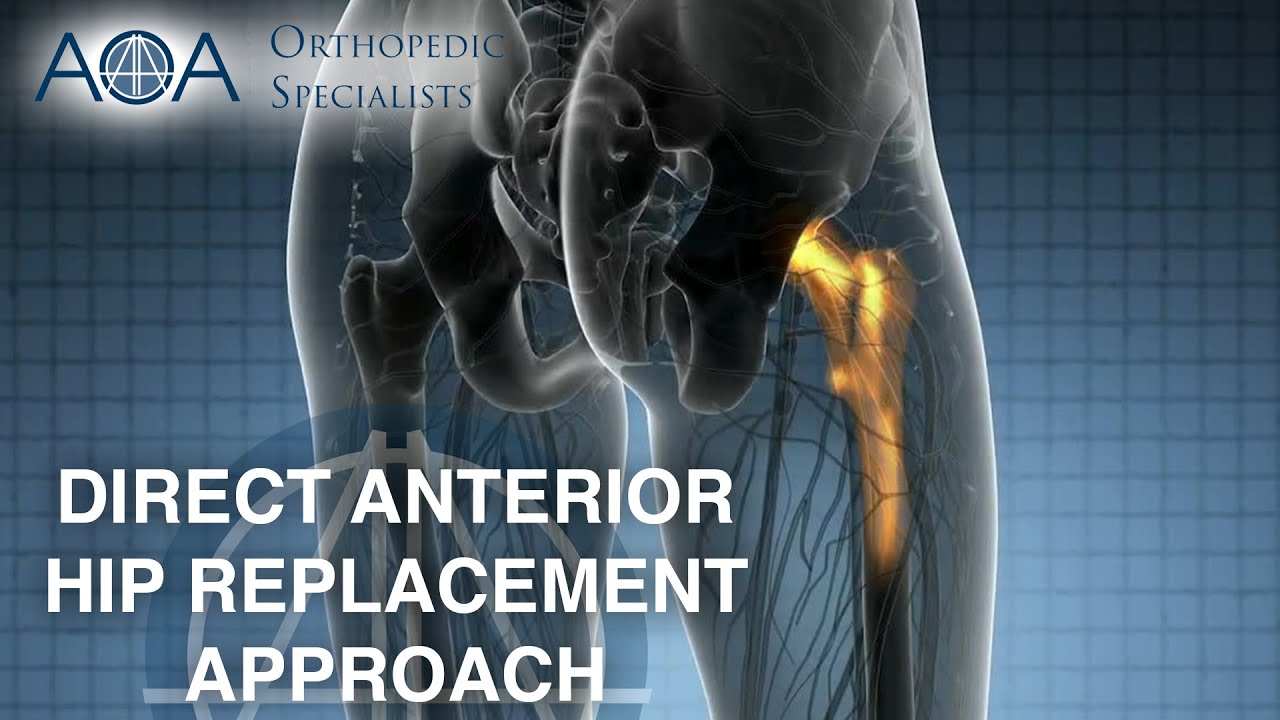 Direct Anterior Hip Replacement Approach