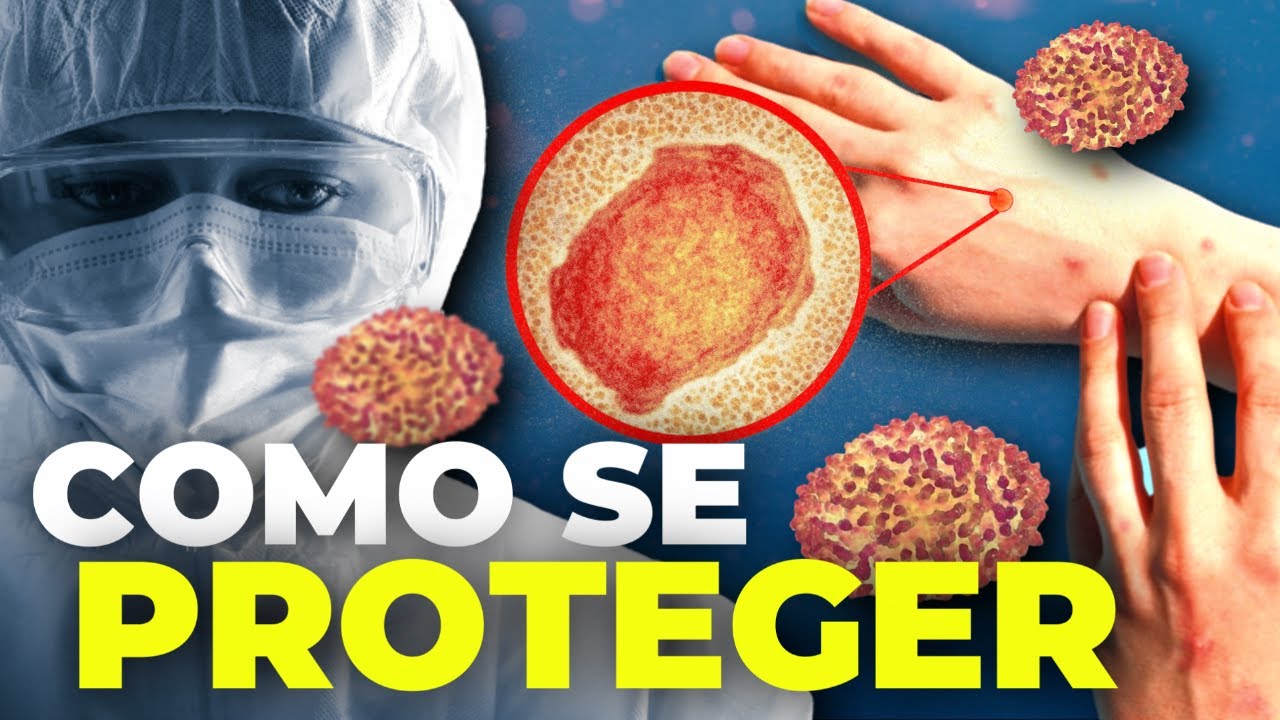 MPOX: COMO SE PROTEGER