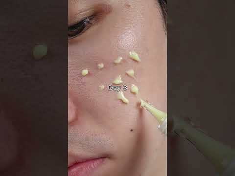 retinal with 7days#kskincare #skincare #skincareroutine #retinal #serum #pores #darkspots #kbeauty