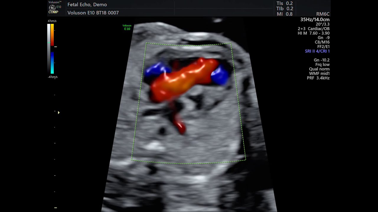 AVALIAÇÃO DE ARTÉRIA PULMONAR FETAL