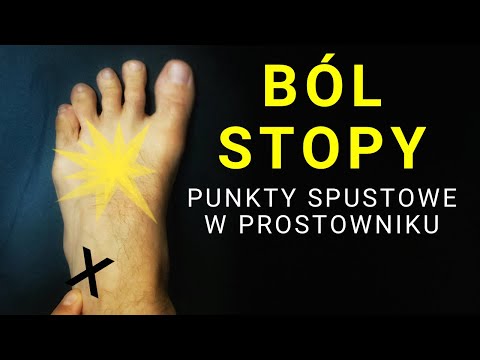 BÓL STOPY - punkty spustowe w prostowniku krótkim palców - dr n. med. Marcin Wytrążek