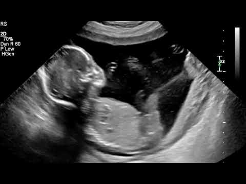 19 WEEKS 3 DAYS ULTRASOUND/SCAN Active Baby