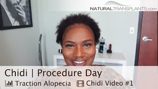 Alopecia | Natural Hair Transplant | Procedure Day (Chidi)