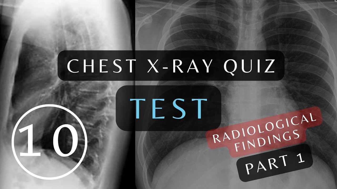 Can You Pass This Quiz: Questions and Answers | 10 Essential Chest X-rays #xray #respiratory