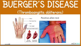 Buerger’s Disease Explained | Symptoms, Diagnosis, and Treatment (Thromboangiitis Obliterans)