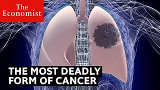 How to detect the deadliest form of cancer | The Economist