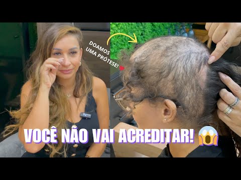 ALOPECIA, DONATION, CAPILLARY PROSTHESIS, TRICHOTILLOMANIA