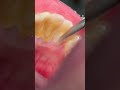 Scaling Cleaning Tartar Teeth Tooth Satisfying