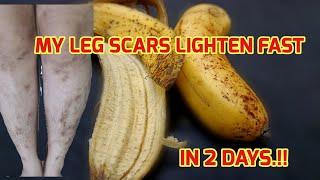 HOW MY LEG SCARS LIGHTEN FAST IN 2 DAYS USING REMEDIES WITH banana peel, SCAR,MOSQUITO BITES ON LEGS
