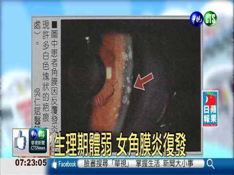 生理期體弱 女角膜炎復發
