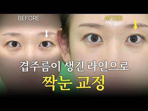 원하는 눈쪽의 겹주름 라인으로 짝눈 교정 해주세요. · 韩语