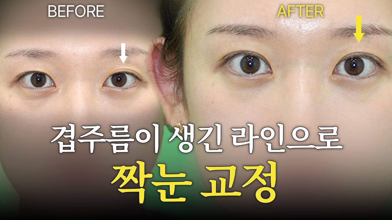 원하는 눈쪽의 겹주름 라인으로 짝눈 교정 해주세요. 썸네일 — 마침표성형외과 눈성형 영상