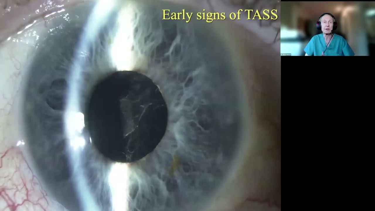 Lecture: Toxic Anterior Segment Syndrome (TASS): Causes, Prevention, and Updates