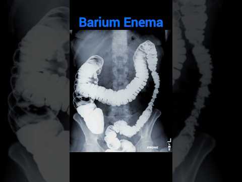 Barium Enema